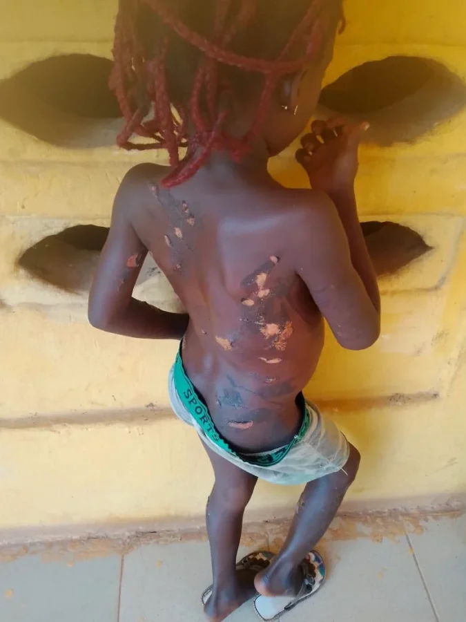 Mother Arrested Over Alleged Hot-Knife Injury to 7-Year-Old Daughter in Anambra